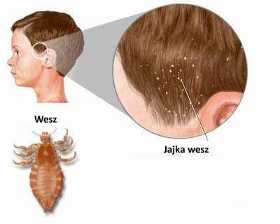 Wszy